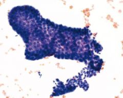 "Papillary lesion"
Can't tell benign from malignant on cytology
 3D sheets, usually bloody, usually central

vs. FA: Papillary lesions are DYSHESIVE at edges