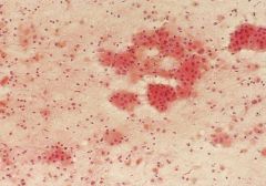 Warthin tumor
PAROTID
MEN 50-70y
MOTOR OIL fluid

lymphocytes, oncocytes, granular debris
granular pink cytoplasm on pap; blue on air