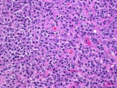 Castleman's Disease, plasma cell type
Systemic / multicentric
Diffuse plasma cell proliferation interfollicular
** symptomatic & poor px: F, anemia, elevated ESR, hypergammaglobulinemia, and hypoalbuminemia