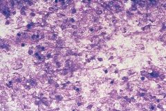 Mycobacteria
Negative staining

Granulomas, necrosis
AFB STAIN