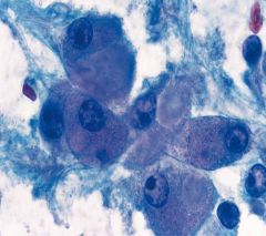 Fibrolamellar HCC
Young patients
Good px
No cirrhosis
Very large hepatocytes
hyaline globules
Dense fibrosis around tumor cells