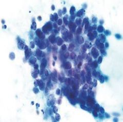 metastatic small cell

Small blue cells scant cytoplasm
Molding
benign hepatocytes
high N:C
Granular chromatin
