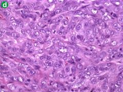 Undifferentiated (anaplastic) carcinoma
var of ductal adeno
Highly cellular smears, pleomorphic cells
Osteoclast like GIANT CELLS
PHAGOCYTOSIS OF INFLAM CELLS & RBCs

r/o mets