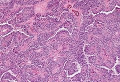 Solid pseudopapillary neoplasm
Uncertain malignany potential
No preference for pancreatic site
Young women

Highly cellular
Hyalinized vascular stalks lined by neoplastic cells
Cells not very pleomorphic; small; occasional grooves

IHC+: a1aT, PR