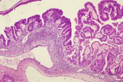 Mucinous cystic neoplasm
5% pancreatic tumors
Found only in women
BODY & TAIL
Mucinous epithelium
does NOT connect to ductal system
OVARIAN TYPE STROMA
Can be b9, borderline, or malignant