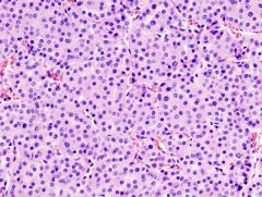 Oncocytoma
• highly cellular
• rounded nests (cell block)
• cohesive fragments and dyshesive cells (smears)
• abundant uniformly granular cytoplasm
• Fuhrman grade 2 nucleoli

r/o hepatocytes (lipofuscin)
r/o RCC (more cohesive, more atypia)
r/o 