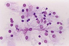 Clear cell RCC
-large cohesive cell groups with transgressing vessels
-Abundant wispy cytoplasm with ILL-DEFINED edges
-Vacuoles
-Large round eccentric nuc
BLOODY

genetics?