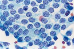 Papillary RCC (10% RCCs)

Type 1: Fuhrman1,2. Small, scant cyt. Low grade, more common. foamy macrophages and i/cyt hemosiderin

Type 2: Large cells abundant granular cyt. Large nuc, prom nucleoli (F3)

Note large sphere in 1st image, characteristic