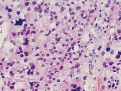 Adrenal cortical carcinoma
Uncommon
Usually fxnl

Isolated cells with INTACT granular cytoplasm (vs adenoma) 
Pleomorphic nuclei
Mitoses

IHC?