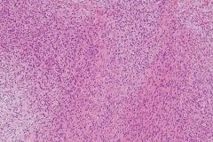 low-grade fibromyxoid sarcoma
looks bland but 30% metastasize
myxoid matrix
bland spindle cells

genetics?
