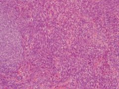 Synovial sarcoma

Characteristic pattern of cohesive cell clusters alternating with dispersed cells

genetics?
