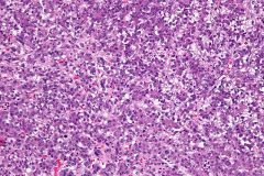 hepatoblastoma

#1 liver neoplasm in kids <3y
cells range from poorly diff to adult hepatocytes
endothelial cells surround abnormal trabecular cords > 3 cell layers thick
Mits
EMH!
