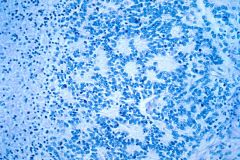 Neuroblastoma

Small primitive cells
Homer-Wright rosettes
Neuropil

IHC: (+)Chromo, synapto, ALK

EM?