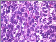 Myxoid liposarcoma

- CHICKEN WIRE BVs
- Myxoid matrix
- Adjacent ROUND CELL component