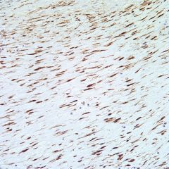 Fibromatosis
-Benign myofibroblasts, parallel arrangements, elongated BVs, infiltrative
-From fascia

Superficial vs. deep fibromatosis

NUCLEAR B-catenin
inactivation of APC t.s. gene
also +SMA, MSA, vimentin, calponin; (-)CD34

GARDNER SYNDOME