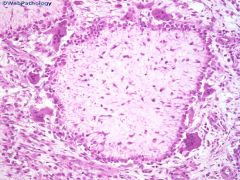 Chondromyxoid fibroma

MONOPHASIC lesion

Spindled cells
may see focal atypia
osteoclast-like giant cells at edge
CHUNKY calcification
zonation (hypocellular in center, more cellular at periphery)

Lobules of myxoid cartilage
(how is this diff 