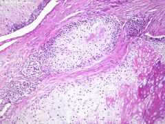 Chondroblastic osteosarcoma (25% of conventional OS)

Makes high-grade hyaline cartilage

how to ID vs. chondrosarcoma?