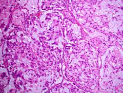 Epithelioid hemangioendothelioma
rare
Cords & nests of pink endothelial cells
Don't make vessels, unlike hemangiomas
Usually bland. 
CAN METASTASIZE

IHC?
Genetics?