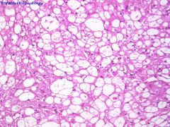 Chordoma
This is a malignant tumor!
USUALLY WITH LARGE SOFT TISSUE EXTENSION
Lobules of cells separated by fibrous septae
Myxoid matrix
Mild to moderate atypia

PHYSALIFEROUS CELLS! (bubbly cytoplasm)

What is important to know about the sampling