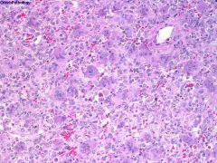 Giant cell tumor of bone
Usu 20-50y
Benign but very locally aggressive & fast growing

Mononuclear cells & giant cells (NUCLEI OF BOTH ARE THE SAME)
Mononuclear cells have SCANT cytoplasm

Grossly, red-black with hemorrhage

Site?
DDx?