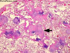 What pneumoconiosis is indistinguishable from sarcoidosis on histology?