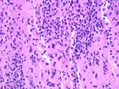 IHC for large cells in this lesion?