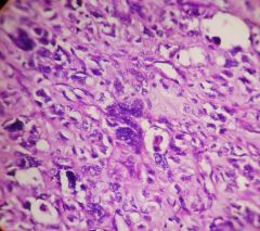 Pleuropulmonary blastoma is an aggressive tumor characterized by mesenchymal elements (including undifferentiated blastema and often cartilaginous, rhabdomyoblastic, or fibroblastic differentiation) and epithelium-lined spaces.