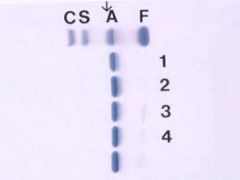 The patient is in lane 1. There was an abnormal hemoglobin on alkaline gel in the C lane. What is it?