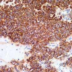 Ewing Sarcoma
IHC?
genetics?
what translocation imparts a more favorable px?