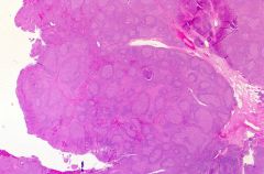 Marked follicular hyperplasia with giant irregular shaped follicles. Can involute and show depleted follicles with fibrosis.