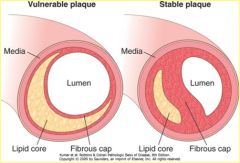 The more fibrous cap on the lipid core, the more stable the plaque.
