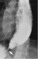 ___________ is a primary esophageal motor disorder of unknown etiology characterized by insufficient lower esophageal sphincter relaxation and loss of esophageal peristalsis.