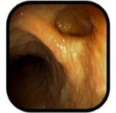 1. A 79 year old male is admitted to the hospital with aspiration pneumonia. He gives a significant history of dysphagia and regurgitation of undigested food material. His wife of 55years complains of severe bad breath. Below is the endoscopic appearance,