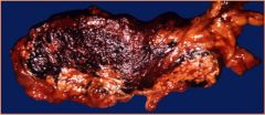 This is...
A. acute hemorrhagic pancreatitis
B. adenocarcinoma of the extrahepatic bile ducts
C. primary sclerosing cholangitis