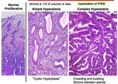 Remember, normal = > 50% stroma with glands peppering. 
Simple hyperplasia just means stroma is 1/3 or less of volume. 
Complex hyperplasia means that glands have been more complex but importantly, they still have endometrial stroma between the glands!!