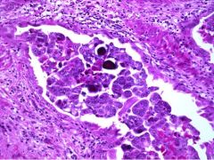 E. ALL ARE TRUE

A. Is very aggressive and can disseminate rapidly thru the peritoneum even without evident myometrial invasion
B. p53 mutation is associated
C. precursor lesion associated is endometrial intraepithelial carcinoma
D. psammoma bodies (