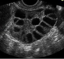 Your patient comes in complaining of hirsutism, central obesity and oligo-ovulation and oligomenorrhea.  On ultrasound her ovaries look like this.  What condition does this patient have?