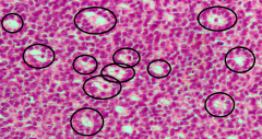 Disarrayed granulosa cells in eosinophilic fluid