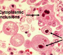 Enlarged cells with intranuclear inclusion bodies