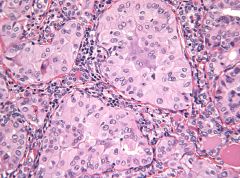Enlarged thyroid cells with ground-glass nuclei