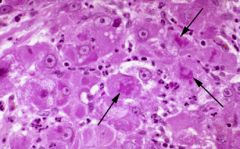 Eosinophilic cytoplasmic inclusion in liver cells