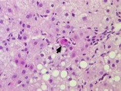 Eosinophilic globule in liver
