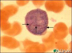 Azurophilic granular needles in leukemic blasts
