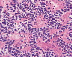 Circular grouping of dark tumour cells surrounding pale neurofibrils