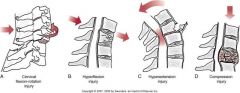 - flexion and rotation injury
- posterior spinal ligaments rupture and upper vertebra is displaced over lower vertebra
- rupture of intervertebral disc and, in severe cases, anterior longitudinal ligament can occur
- transection of SC is often associat