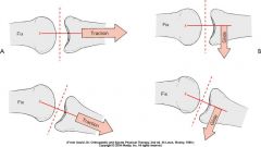 - distraction/traction techniques applied perpendicular to treatment plane

- sliding/gliding techniques applied parallel to treatment plane