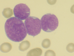Cytogenic feats of Acute lymphoblastic leukemia
Nucleus configuration
Chromatin pattern
Nucleoi
Cytoplasm
