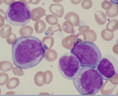 -Cytogenic feats of Acute meyloblast leukemia
Nucleus configuration
Chromatin pattern
Nucleoi
Cytoplasm