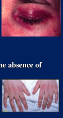 Gottron’s papules and heliotrope eyelids
Humorally mediated vasculitis
Adult form associated with malignancy