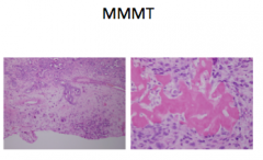 in the setting of endometrial atrophy with Endometrial Intraepithelial Carcinoma-malignant-appearing cells in pre-existing epithelium
   -p53 mutation is early event in carcinogenesis
   -Usually high stage at presentation, aggressive